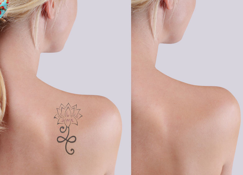 laser tattoo removal machine