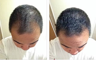 Man with short black hair whose hair is thinning on left and right side of his hairline