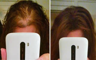 Woman whose straight brown hair is thinning on her frontal scalp