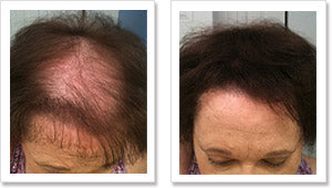 Woman with straight black hair whose hair is thinning on her frontal and middle scalp