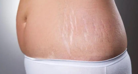 how to fade stretch marks