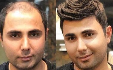 men's hair systems before and after