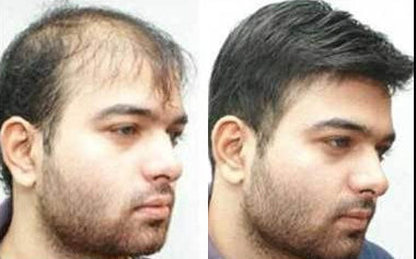 men's hair systems before and after