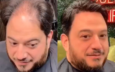 men's hair systems before and after