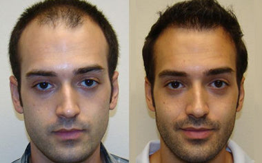 men's hair systems before and after