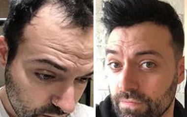 men's hair systems before and after