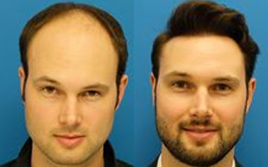 men's hair systems before and after