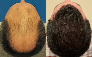 men's hair systems before and after