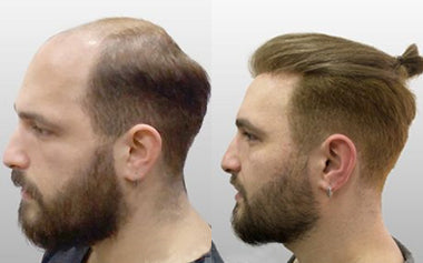 men's hair systems before and after