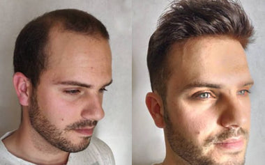 men's hair system photos