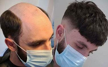 men's hair systems before and after