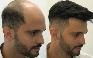 men's hair systems before and after