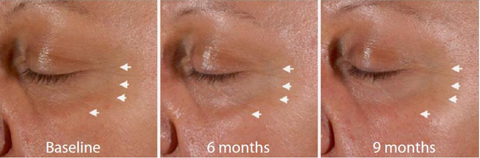 Comparison of the effects of 0.1% retinol