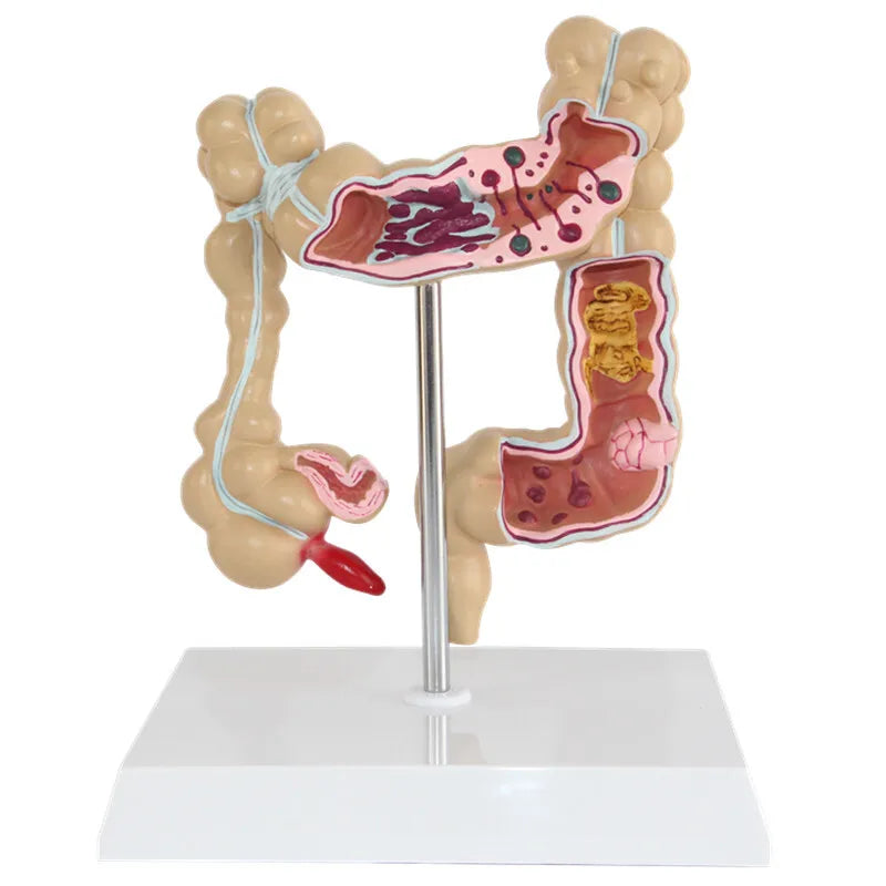 Anatomical Human Colorectal Lesion Model Anatomy Colon Diseases Intestine Medical Teaching Learning Supplies Tool