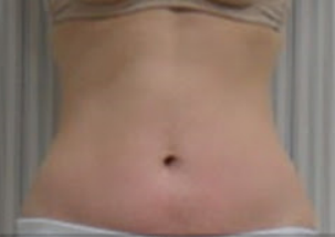 Side effects of ultrasonic cavitation