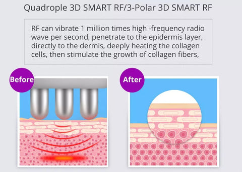 RF Cavitation Machine