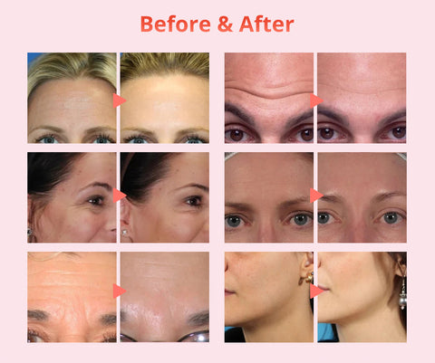 hydrafacial before and after