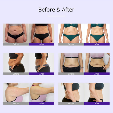 lipo cavitation before and after pictures