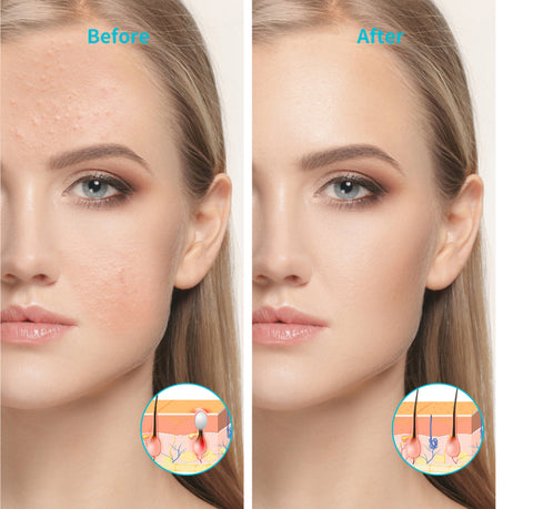 blue therapy light for acne before and after