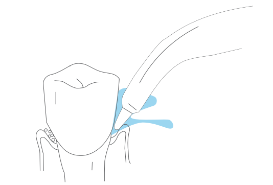 Periodontal Pocket Tip
