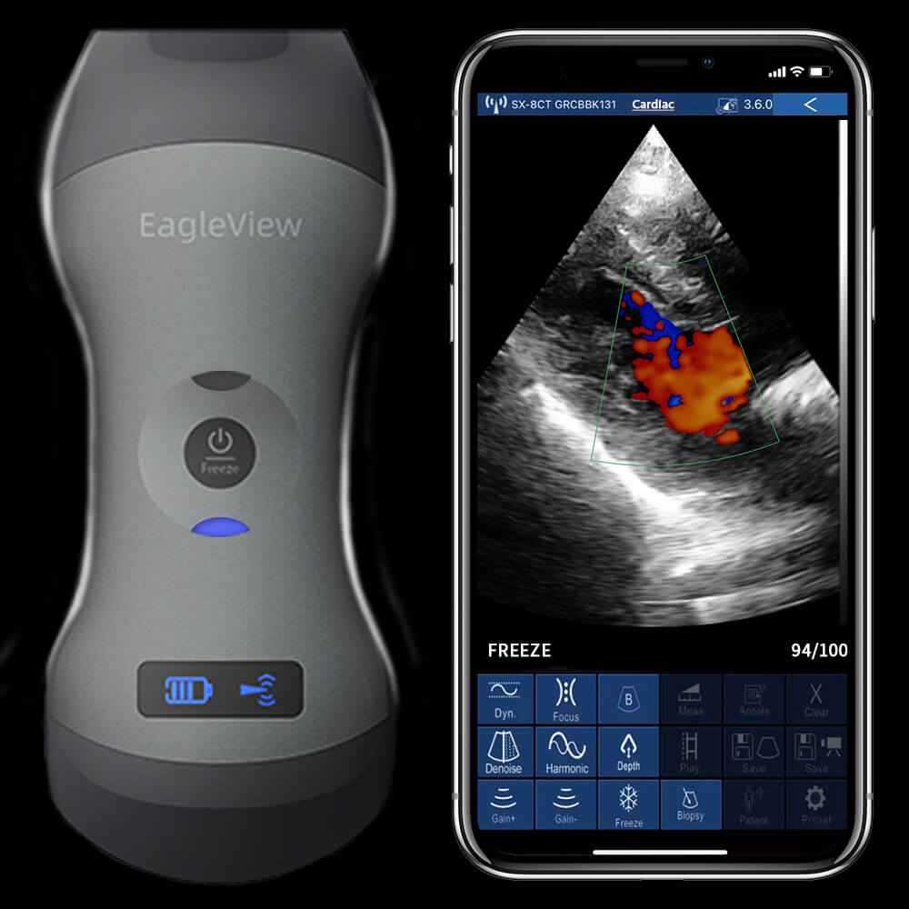 EagleView? Dual-head Wireless Handheld Ultrasound
