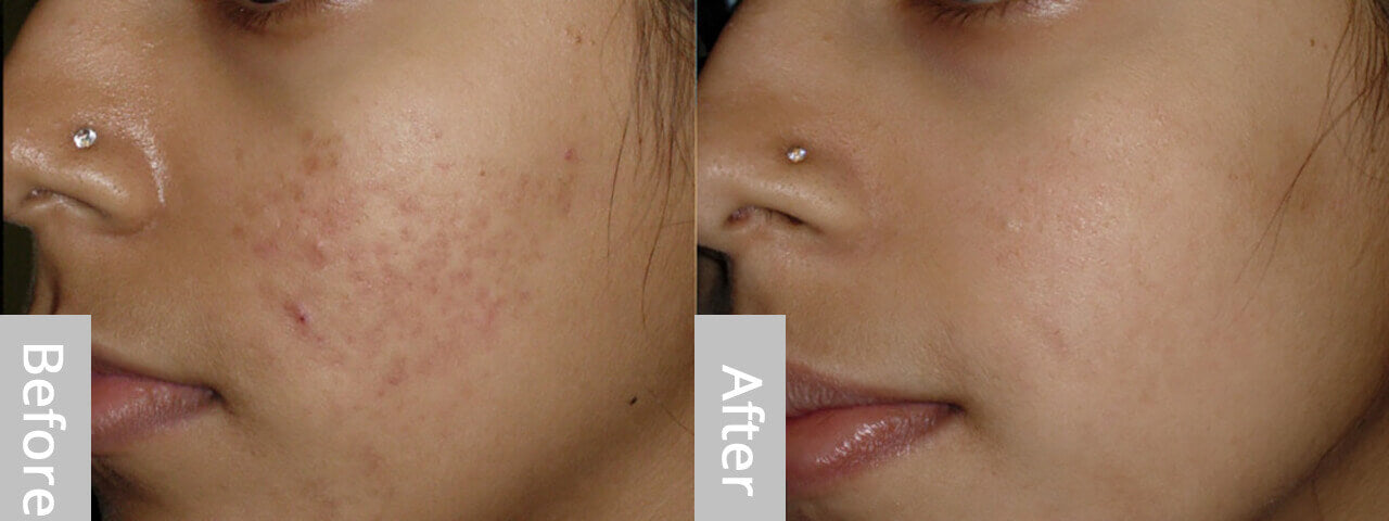 derma roller before and after 03