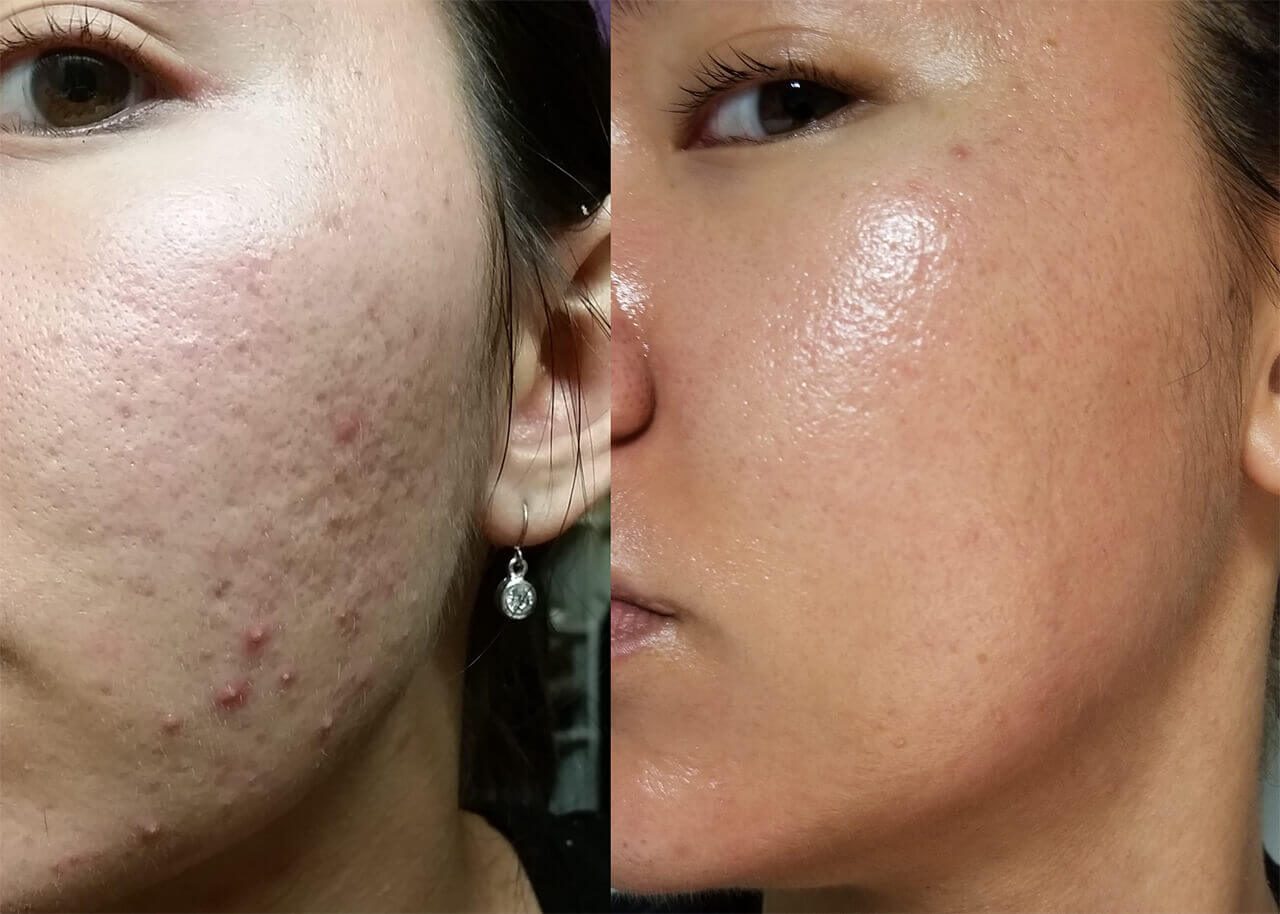 derma roller before and after 04