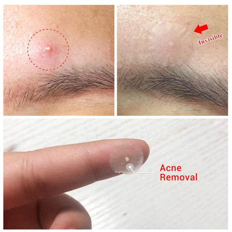 Acne Pimple Patch