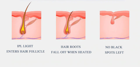 At-Home IPL Laser Hair Removal Device for Women