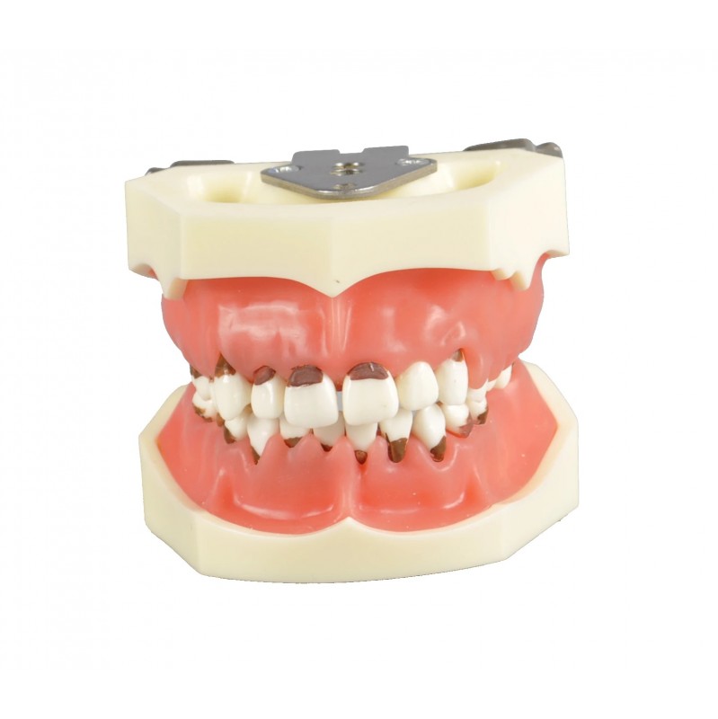 W4024 Dental Periodontal Model with 3 Cases