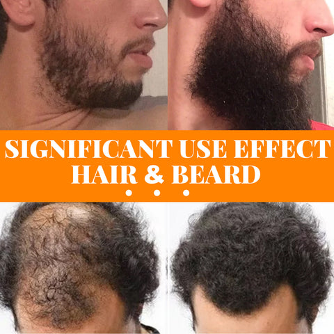 Jaysuing Hair Growth Spray Men's Hair Beard Dense Growth Care Solution –  jaynehoe