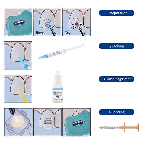 Orthodontic Adhesive No-Mix Direct Bonding Kit 3.5g-azdentall.com