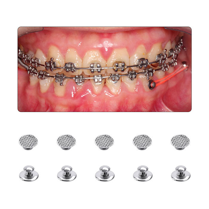 AZDENT Dental Lingual Button Orthodontic Metal Round Mesh Base Bondable 10/Bag AZDENT Dental Lingual Button Orthodontic Metal Round Mesh Base Bondable 10/Bag