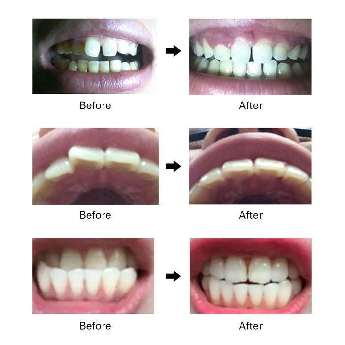 Alignment Trainer Retainers Orthodontic Braces Appliance Tooth Corrector Adult 3 Stages-azdentall.com Alignment Trainer Retainers Orthodontic Braces Appliance Tooth Corrector Adult 3 Stages-azdentall.com