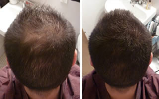 Man with straight dark brown hair whose hair is thinning on the crown and the back of his scalp