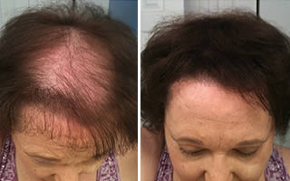 Woman with straight black hair whose hair is thinning on her frontal and middle scalp