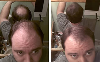 Man with short straight brown hair whose hair is thinning on his crown and frontal scalp