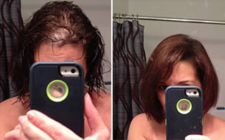 Woman with straight brown hair whose hair is thinning on the parting line and frontal scalp