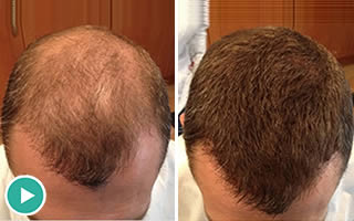 Man With Thin Brown Hair on the Crown and Mid-Scalp Region
