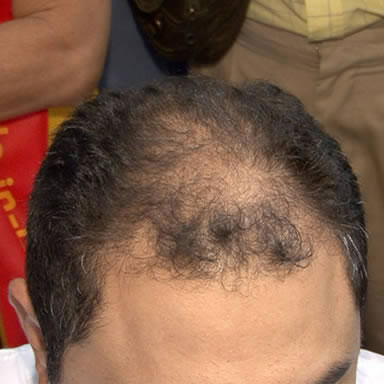 Before Image of a Middle Aged Man with Curly Black Hair that has thin hair in the Frontal and Mid-Scalp Regions