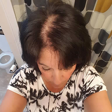 Before Image of a Middle Aged Women with a Middle Part Who Has Thin Black Hair Where Her Hair Parts