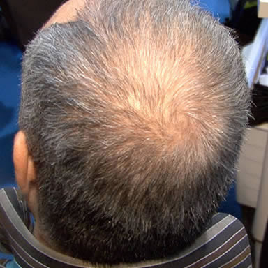 Before Image of an Older Male With Straight Thin Gray Hair Around the Top of his Head