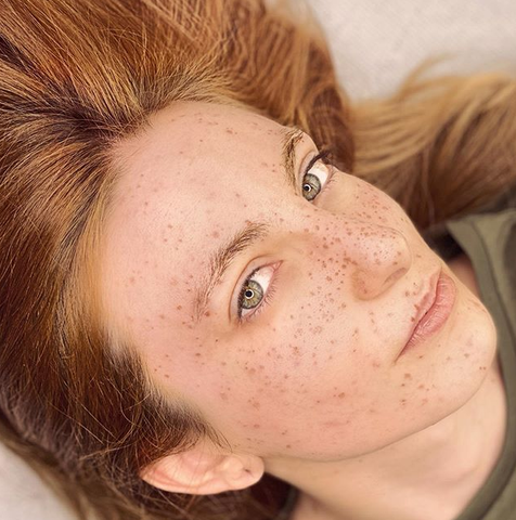 Tattooed Freckles