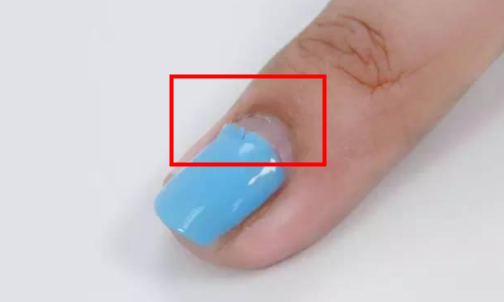 Toddler's toenail falling off :/ - March 2020 Babies | Forums | What to  Expect