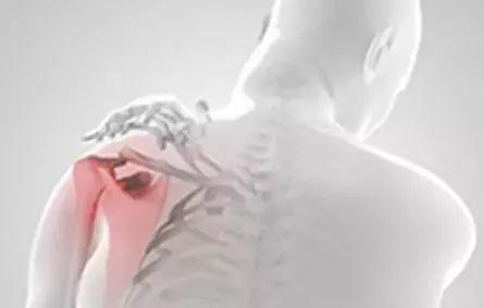 subacromial impingement syndrome