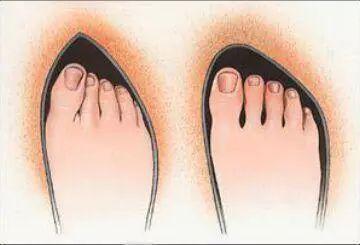 Hallux Valgus