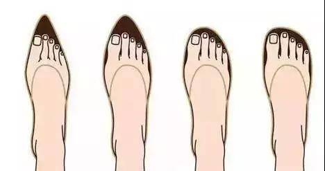 Hallux Valgus