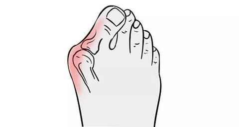 Hallux valgus