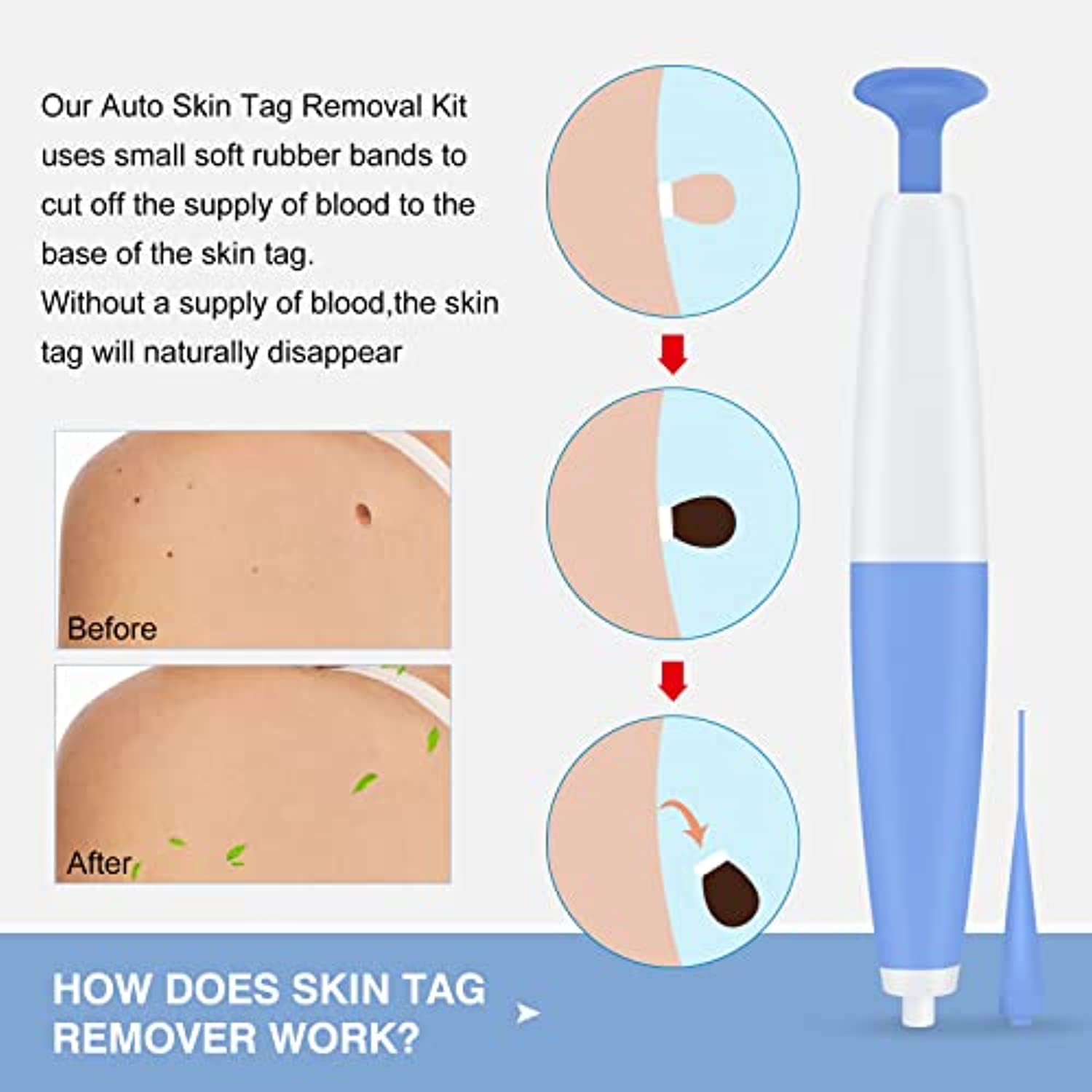 Skin Tag Remover, Skin Tag Removal Kit Tools for Small to Medium Skin Tags, Easy Application Device, Safe and Painless, Suitable for All Body Parts