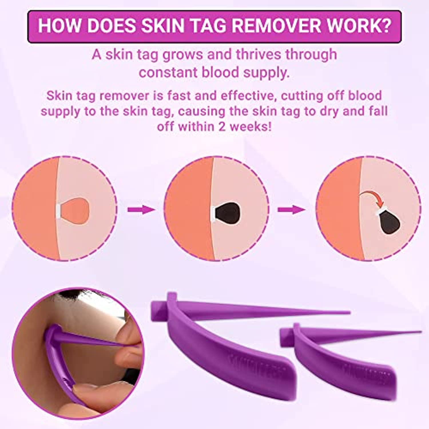 Skin Tag Removal Kit, Small & Standard Skin Tag Remover Device, 36 Pc Repair Patches, Skin Tag Remover Kit for Small and Large Skin Tags (2mm to 8 mm), for Body, Face, Neck, Finger, Arm, Easy, Safe